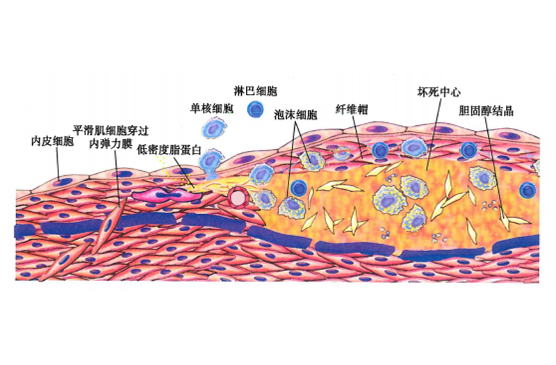 血脂系列：非高密度脂蛋白胆固醇和残粒脂蛋白胆固醇